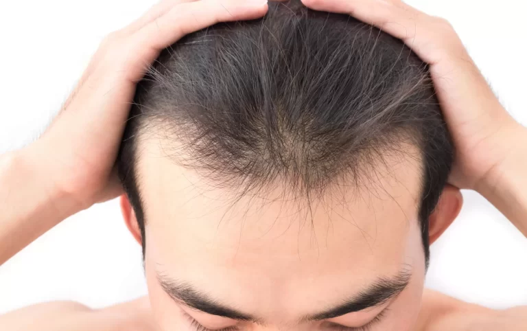 I segreti per fermare la caduta dei capelli e riguadagnare fiducia in sé stessi